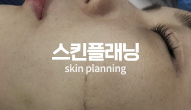 스킨플래닝
